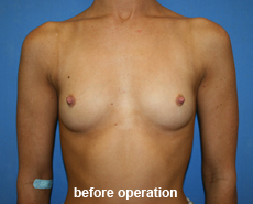 plastic-surgery-breast-augmentation